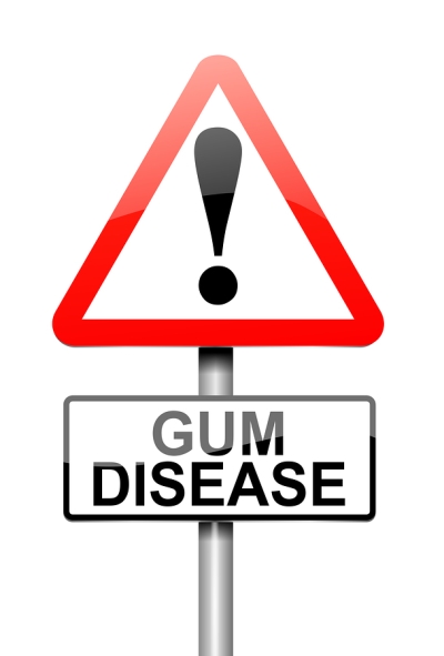 Stages of Gum Disease