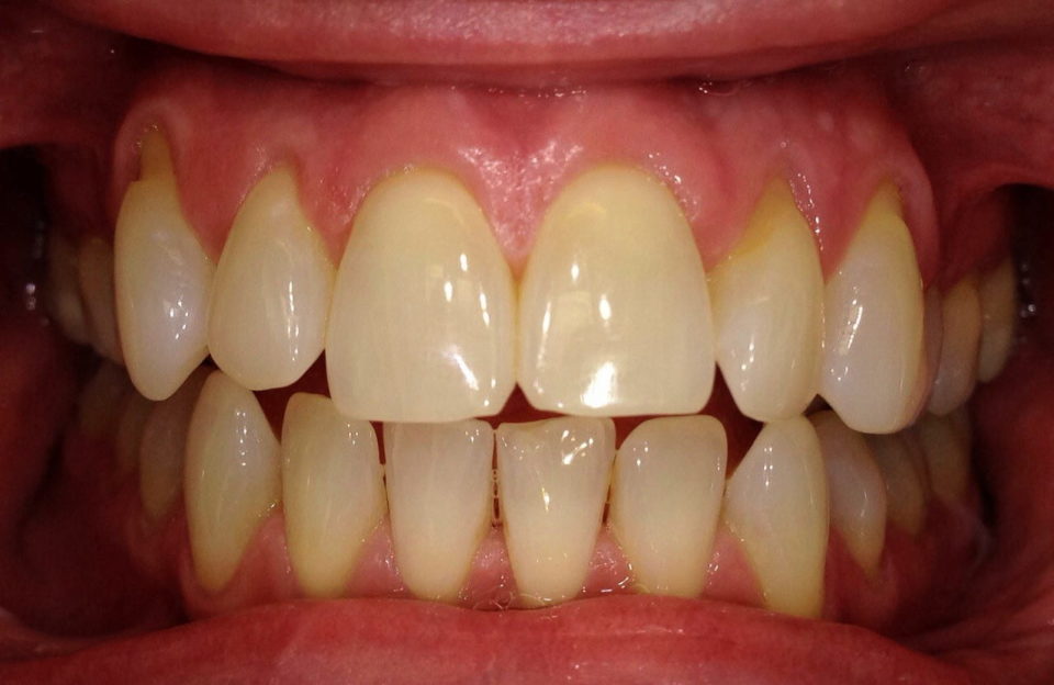 Before Pinehole Surgery Treatment in Denver, CO