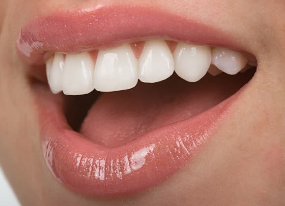 Cosmetic Dental Veeners in Denver, CO