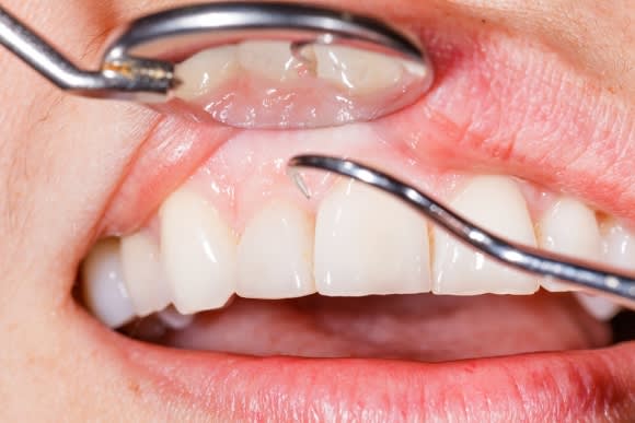 Gum Disease Treatment in Denver, CO