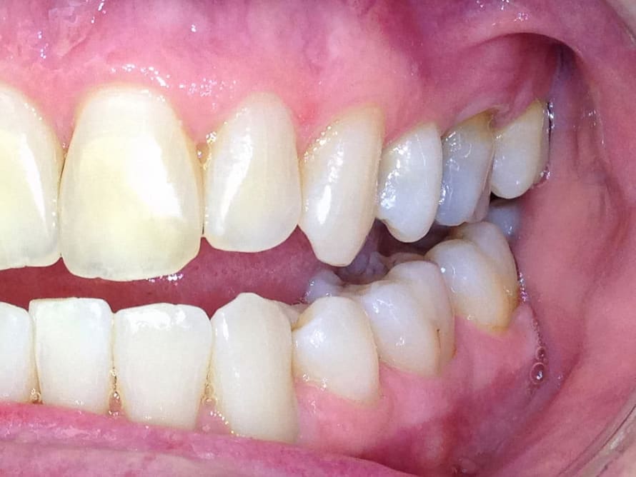 After Gum Disease Treatment at Colorado Advanced Dentistry