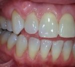 After Gum Recession Treatment at Colorado Advanced Dentistry