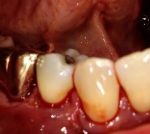 Gum Recession Treatment in Denver, CO