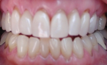 Receding Front Teeth Treatments in Denver, CO