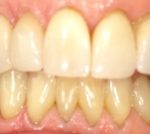 Receding Gums Surgery at Colorado Advanced Dentistry