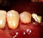 Receding Gums Treatment in Denver, CO