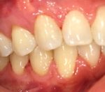 Reverse Receding Gums Treatment in Denver, CO