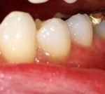 Reversed Gum Recession at Colorado Advanced Dentistry