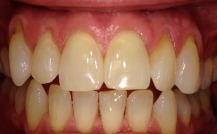 Tips for Preventing Teeth & Gum Disease in Denver, CO