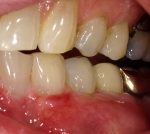 Treating Gum Recession at Colorado Advanced Dentistry