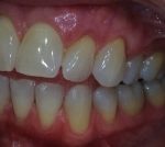 Fix Receding Gums at Colorado Advanced Dentistry