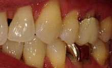 Gingival Recession Treatment in Denver, CO