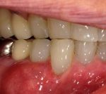 Gum Cleaning Procedure at Colorado Advanced Dentistry