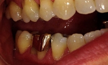 Gum Recession Treatment at Colorado Advanced Dentistry