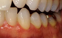 Receding Gums Lower Teeth Treatment in Denver, CO
