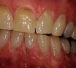 Receding Gums Treatment at Colorado Advanced Dentistry