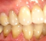 Treating Reverse Receding Gums in Denver, CO