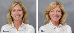 Before & After Photos of Dental Procedures in Denver, CO