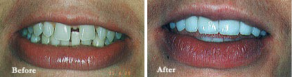 Before & After photos of Dental Treatment in Denver, CO