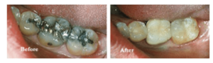 Before & After photos of Teeth Treatment in Denver, CO