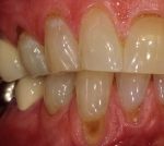 Before Gum Treatment in Denver, CO