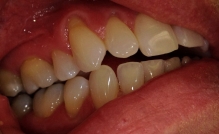Gum Disease Prevention at Colorado Advanced Dentistry