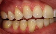 Mild Gum Recession Treatment at Colorado Advanced Dentistry