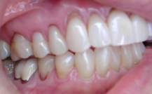 Receding Gums Back Teeth Treatment in Denver, CO