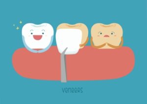 Dental Veneers by Colorado Advanced Dentistry