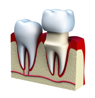 Guide to Dental Crowns in Denver, CO