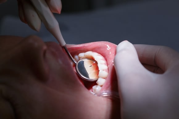 Gum Recession Treatment in Denver, CO