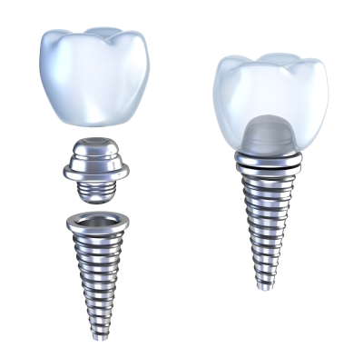 Choosing Dental Implants in Denver, CO