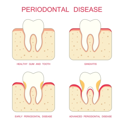 Periodontal Disease Treatment at Colorado Advanced Dentistry