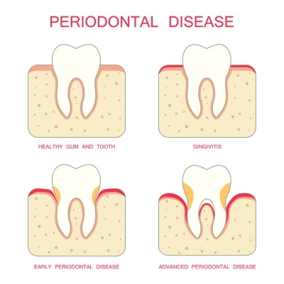 Periodontal Disease Treatment at Colorado Advanced Dentistry