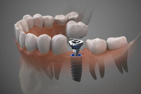Can You Get Dental Implants with Gum Disease