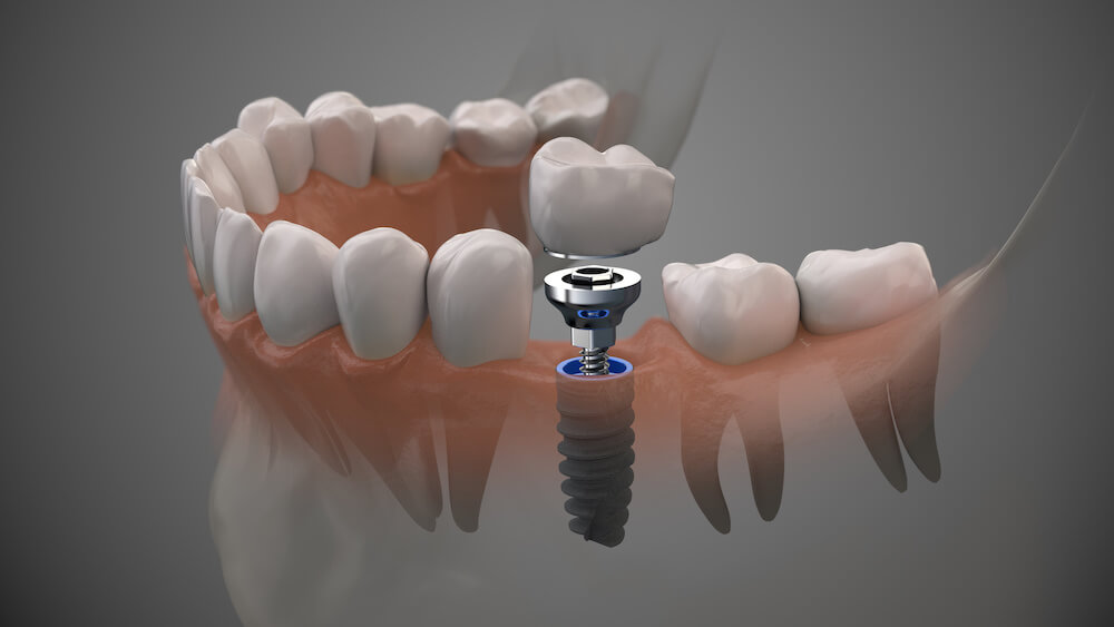 can you get dental implants with gum disease