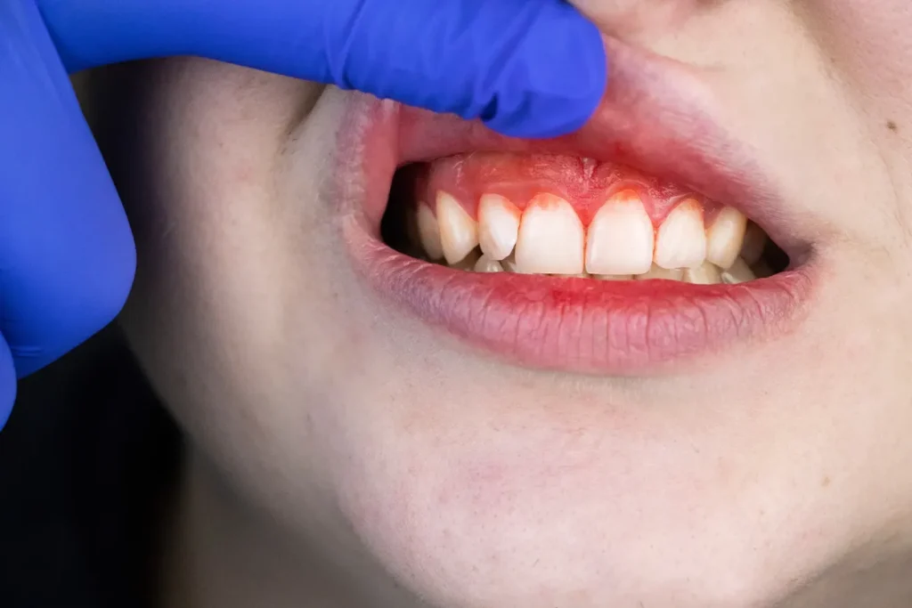 gum disease treatment top 5 options