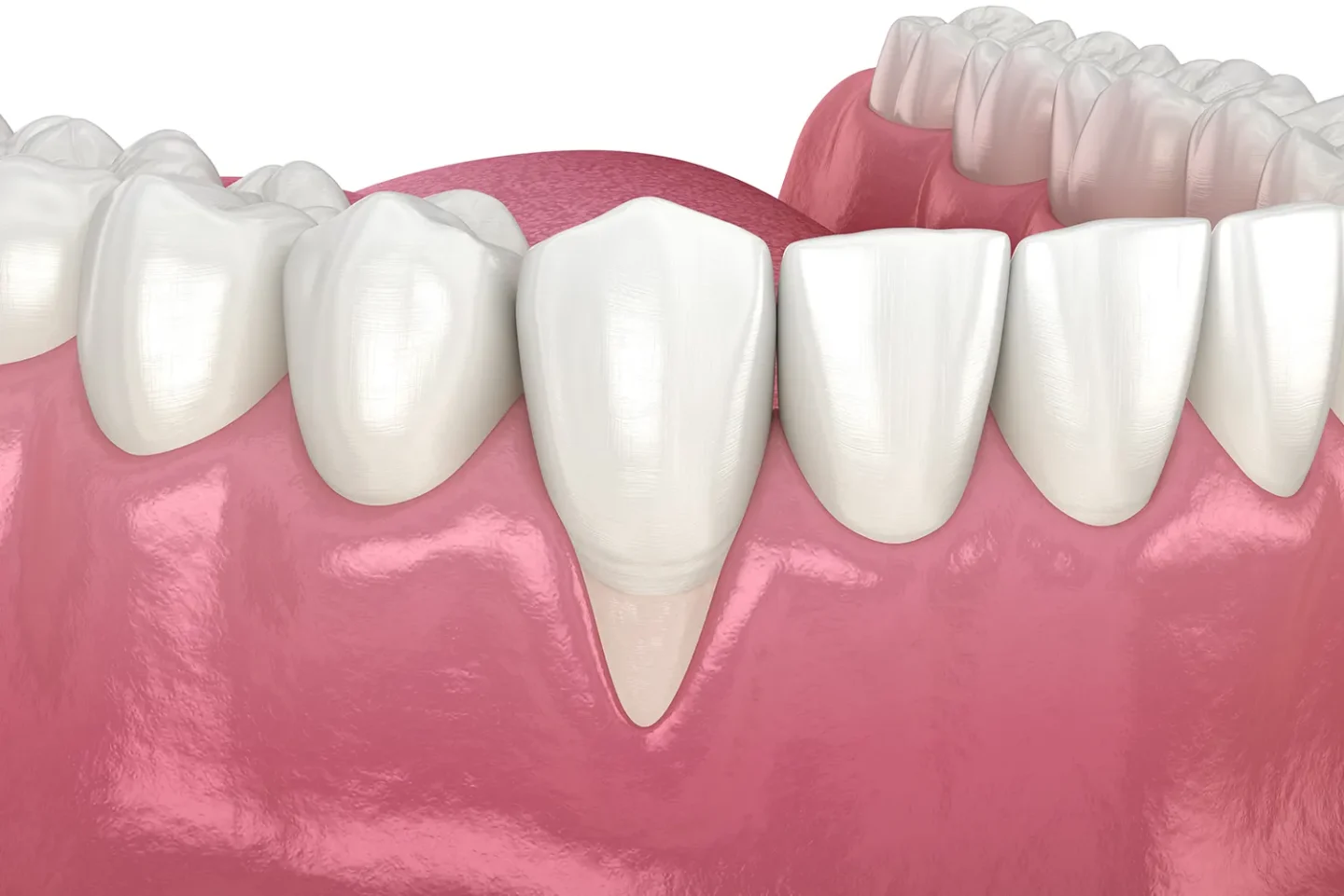 how to treat gum recession