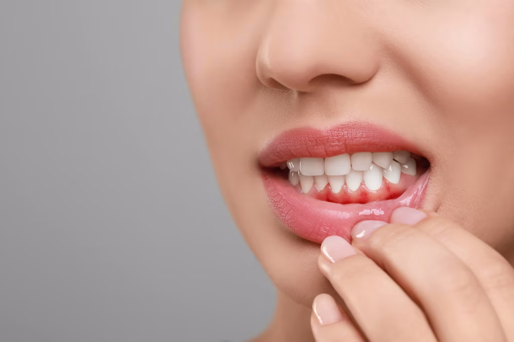 what is gingivitis