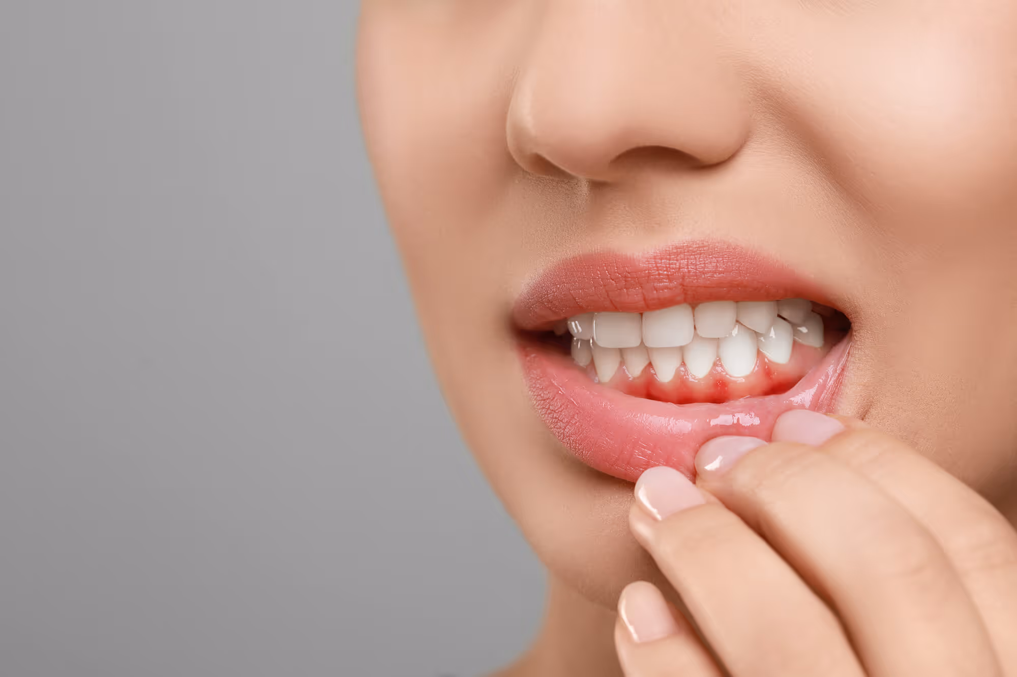 what is gingivitis