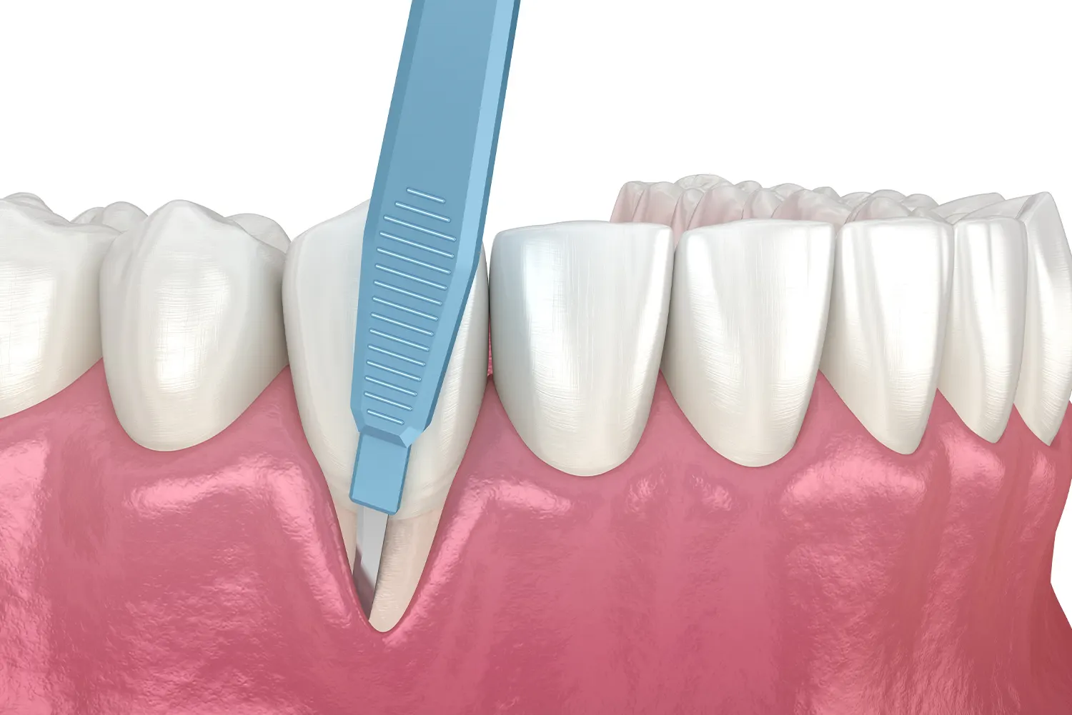 can gum recession be reversed