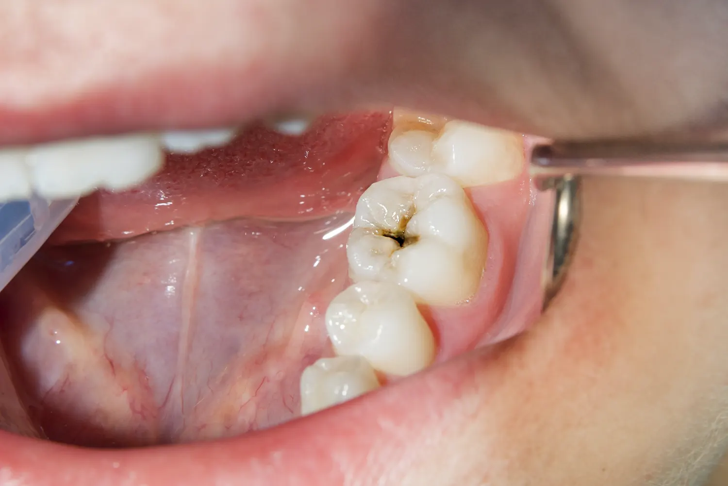 is a cavity a dental emergency