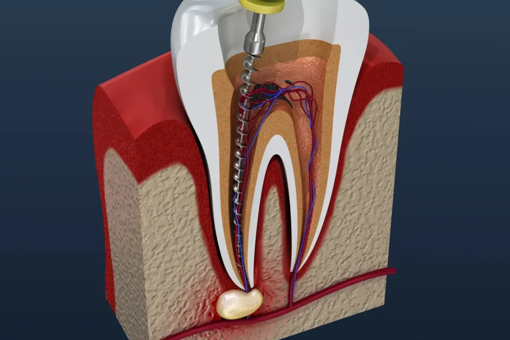 scaling and root planing for gum disease