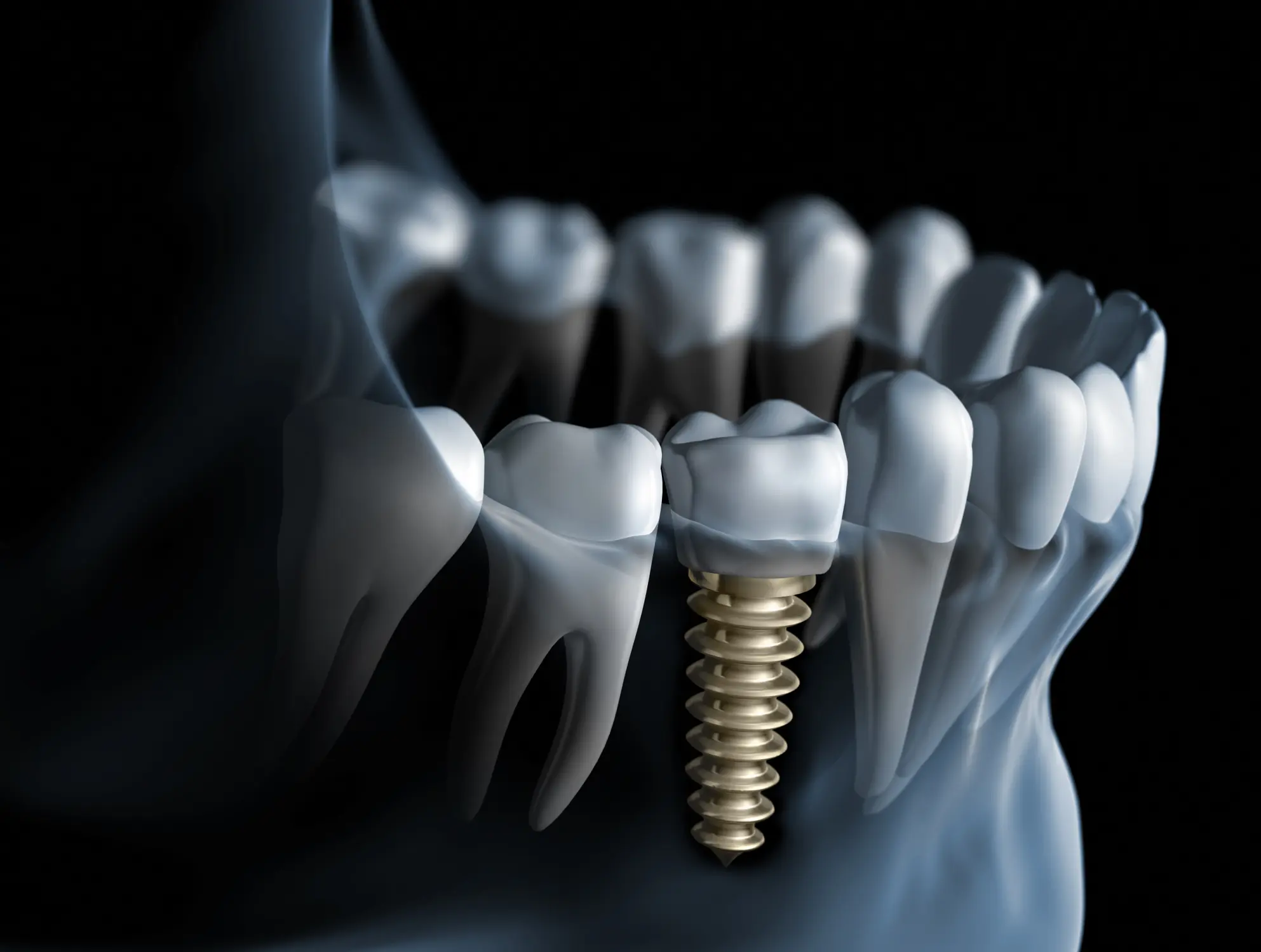 the permanent solution for missing teeth